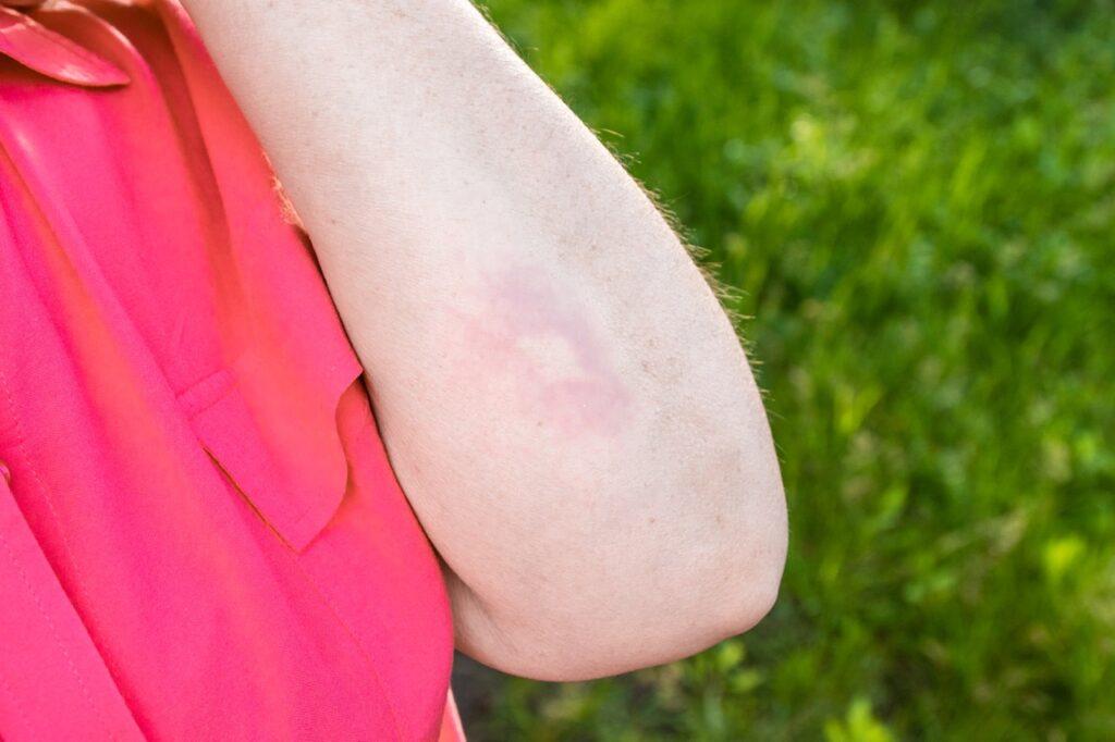 Person stukket av mygg, med myggstikk på underarmen, i rød t-skjorte.
