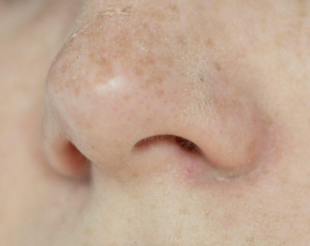 Bilde av tørr hud rundt nese