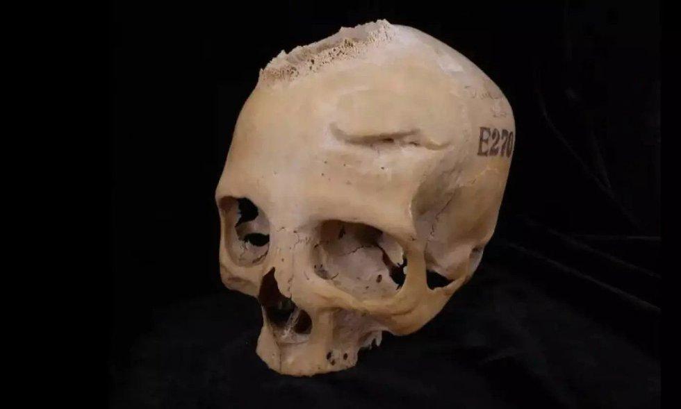 在一位 50 岁左右的埃及女性的头骨上，研究人员发现了肿瘤的痕迹，肿瘤已经破坏了头骨中的骨骼，还发现了她幸存下来的两处伤痕。照片：Tondini、Isidro、Camarós