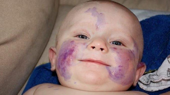 Produkt væv Stor Mathias fikk allergisk sjokk som baby | ABC Nyheter