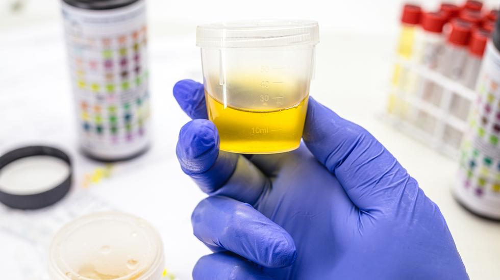 Solution to the mystery of a 150-year-old urine: – Great