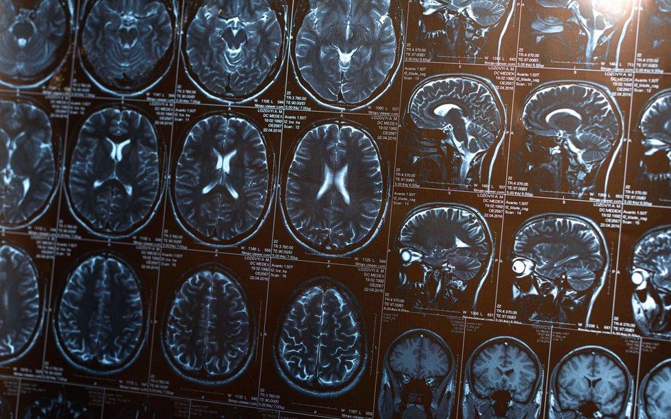 Canadian doctors believe they have the answer to a mysterious, life-threatening brain disease